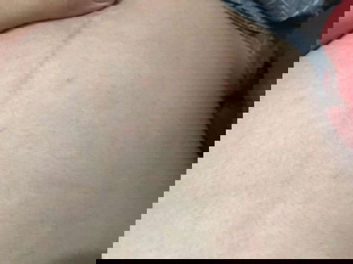 Mụn ở vùng bụng