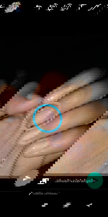 Sakit sela sela kuku