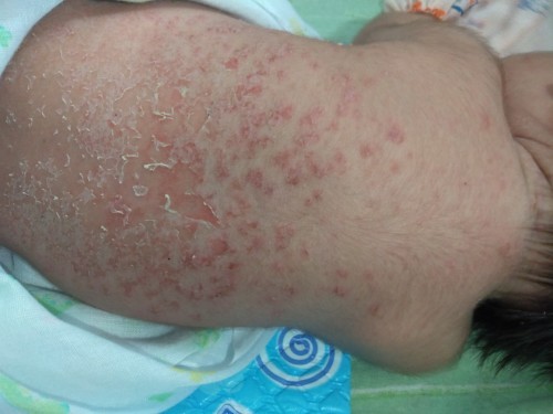 สอบถามหน่อยค่ะลูกเป็นเม็ดหนองแล้วตัวลอก