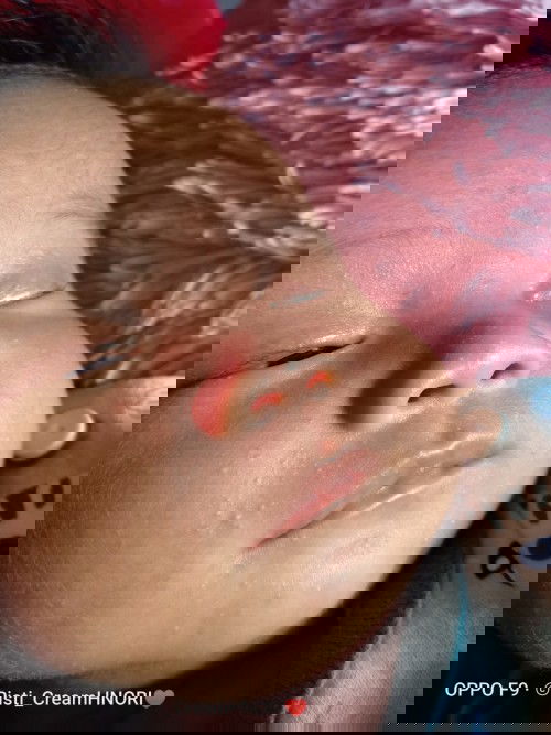 bintik-bintik pada bayi  22hari