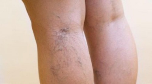 Urat kaki timbul