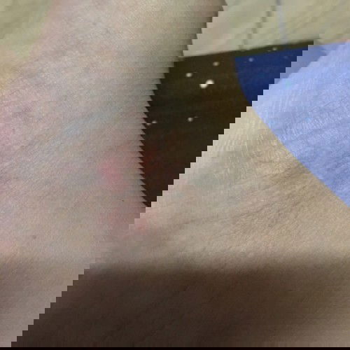 เป็นเส้นเลือดฝอยสีแดงๆมากองตรงที่เป็นรอยแผลเป็นแต่ไม่เจ็บ แบบนี้เป็นอะไรมั้ยค่ะ กลัวครรภ์เป็นพิษ คิดมากเลย กลัวไปหมด😓