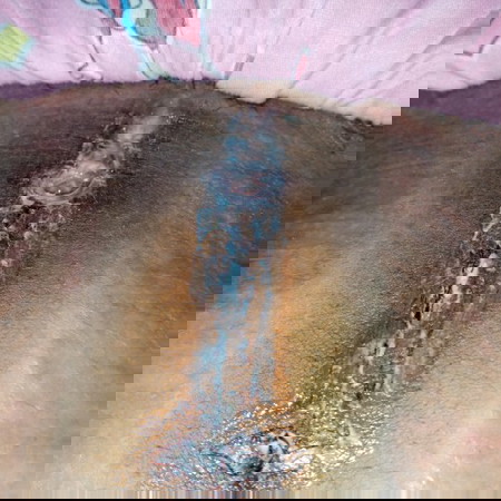 CAESAREAN PROBLEMS