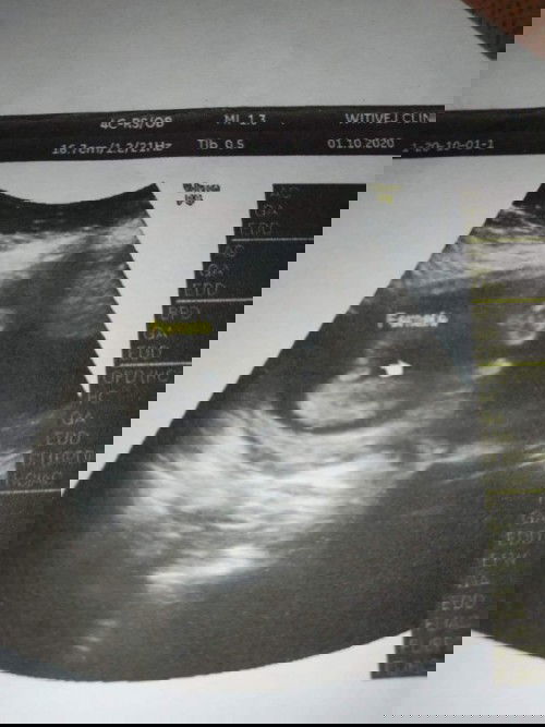 อัลตร้าซาวด์