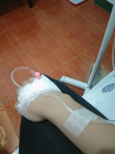 Induced.
