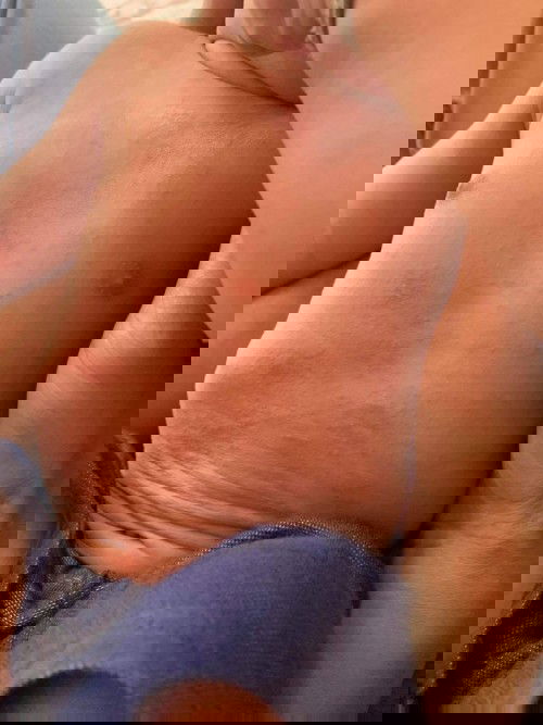 มีผื่นขึ้นแบบนี้ทั้งตัวเลย ก่อนหน้านี้มีไข้แต่ลดแล้ว ไปอนามัยแล้วแต่ไม่ดีขึ้น อาการแบบนี้น่าเป็นห่วง