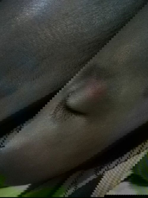 Benjol Merah Dimuka Bayi