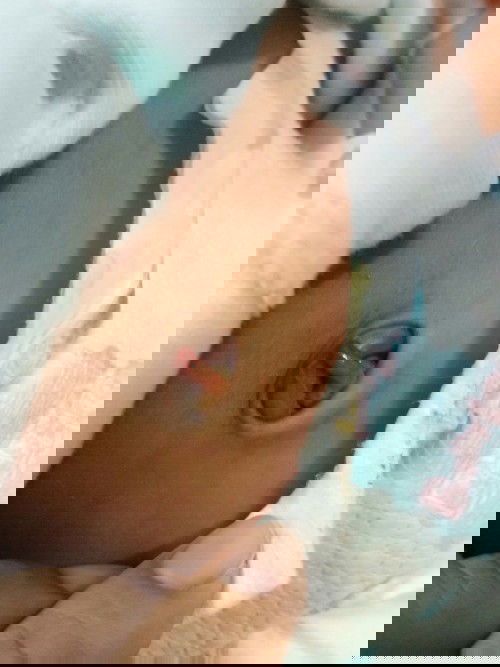 ขอสอบถามหน่อยคะ พอดีวันนี้สะดือลูกหลุด หลุดออกมาแล้วเป็นแบบนี้ครวไปหาหมอมั้ยคะ กล้วว่าจะอักเสบ