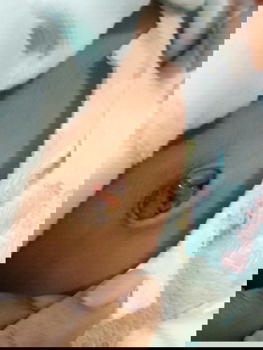 ขอสอบถามหน่อยคะ พอดีวันนี้สะดือลูกหลุด หลุดออกมาแล้วเป็นแบบนี้ครวไปหาหมอมั้ยคะ กล้วว่าจะอักเสบ