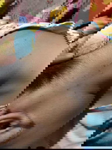 บ้านไหนผื่นขึ้นแบบนี้บ้าง