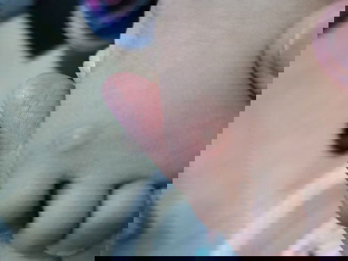 Rashes na nagtutubig?