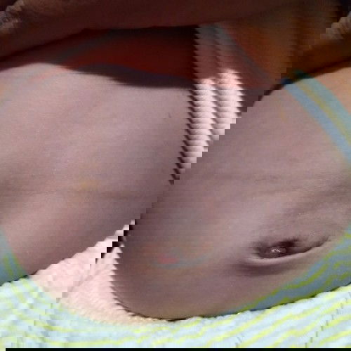 Granuloma Umbilikalis