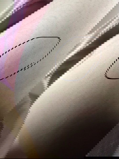 มีรอยบนผิวท้อง