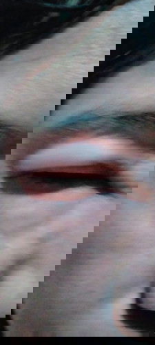 Swollen eyelids