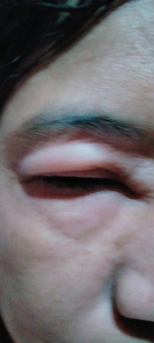 Swollen eyelids