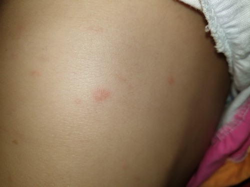 Penyebab Bintik Merah