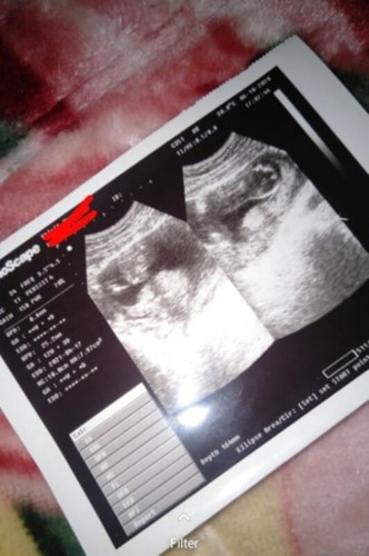 Hamil 12w 5d