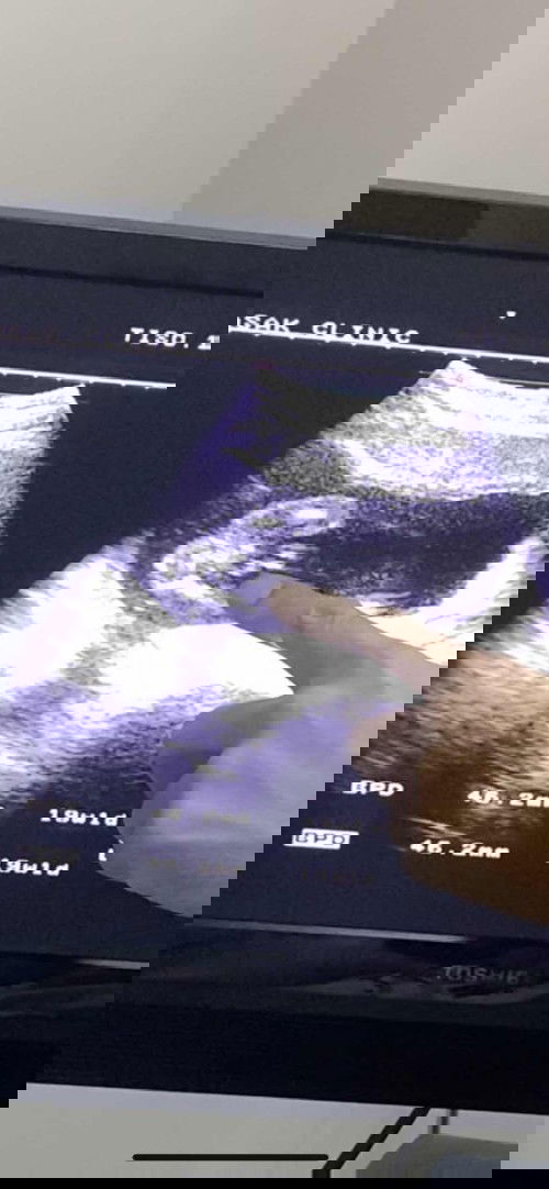 อัลตร้าซาวด์20สัปดาห์