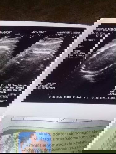 hasil usg noemalkah bayi saya?