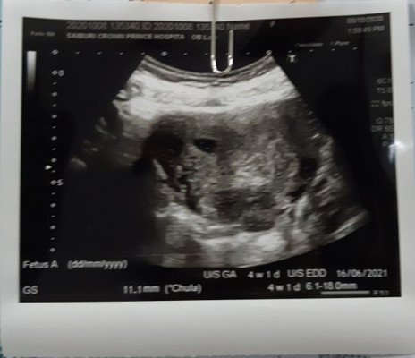 7 wks แต่กลับมองไม่เห็น