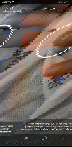 Bun, Ini kenapa ya bun? Obatnya apa?
Awalnya sisi sisi kukunya bengkak, lama kelamaan kukunya copot