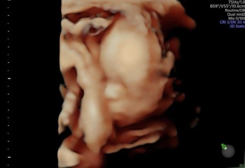 22 week🥰 ครึ่งทางแล้ว