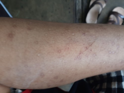 แพ้ยุง ผิวบอบบาง ท้องได้25สัปดาแล้วใช่อะไรทาดี ค่ะ คันมาก เกานิดเดียวก็เป็นแผล พอแผลแห้งก็เป็นจุด