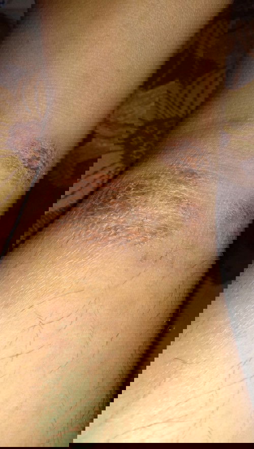 gatal saat hamil TM2