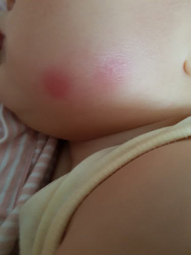 Mosquito bites