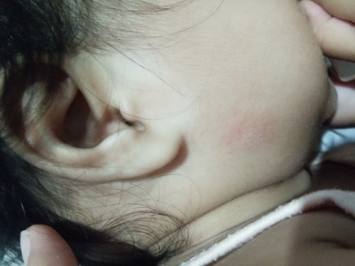 Rashes? FTM