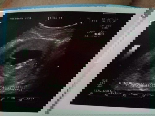 ท้องแรก ท้องแฝดแต่ไข่อีกใบฝ่อ😔