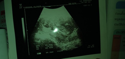 แม่แม่บ้านไหนคลอดมีนา64 บ้างคะ