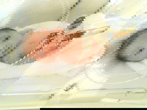 Operasi Caesar Apakah ditanggung BPJS ?