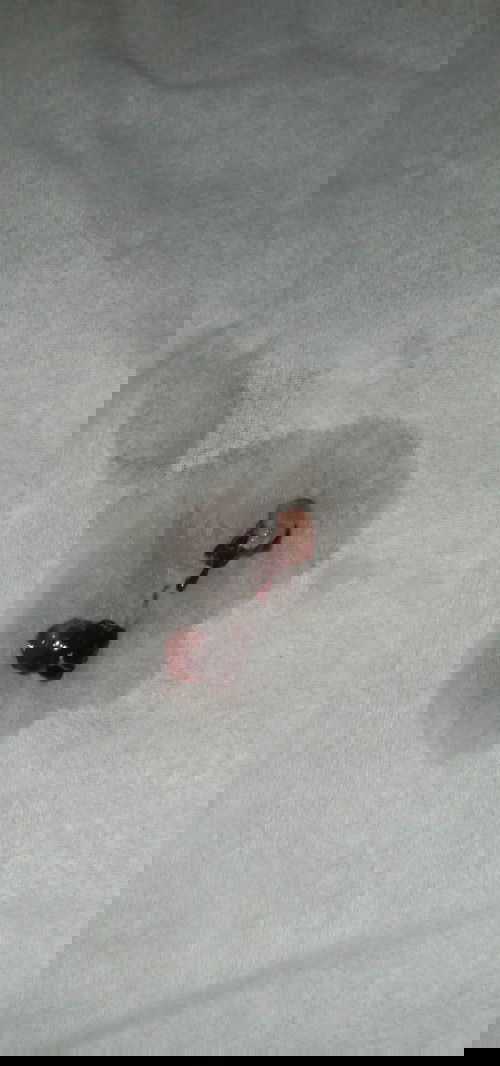 Pipis keluar darah , di UK 20w5d