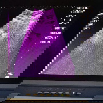 Usg 7 minggu belum terlihat