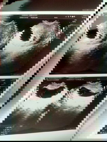 Blighted Ovum? how to cope up with this po? :(