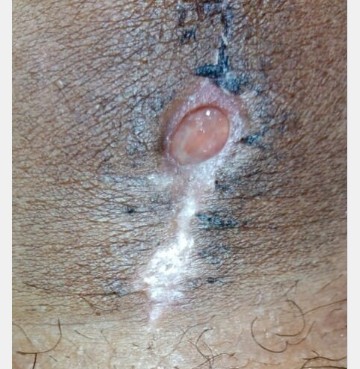 Caesarean section