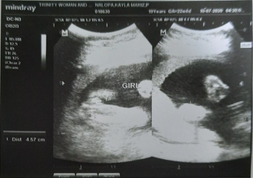 Ultrasound