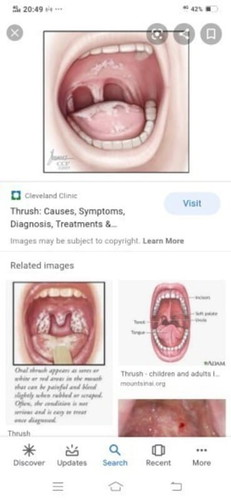 Hi my son suffer with fungel inside mouth and tongue any home remedies.