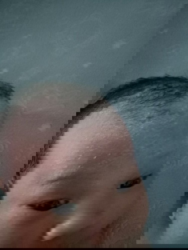 ผื่นแดงตุ่มเหมือนสิวหนอง พอโดนน้ำก็เป็นเหมือนไขแต่ไม่ใช่ไขเช็ดไม่ออก