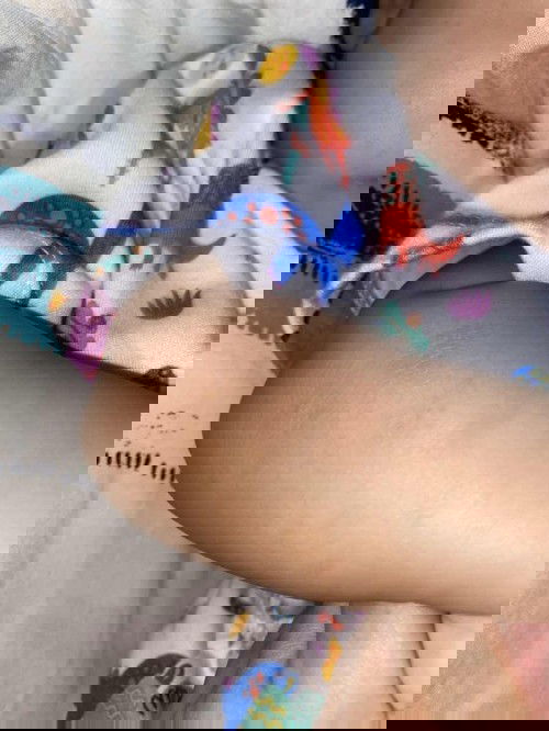 Ruam merah lebar di lengan tangan kanan kiri