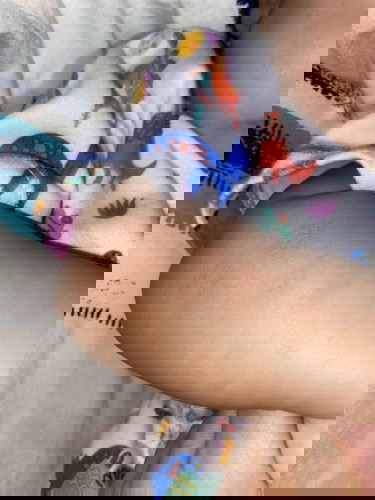 Ruam merah lebar di lengan tangan kanan kiri