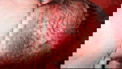 Stork bite, salmon, pink patches.
