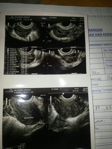 Diagnosa sel telur kecil