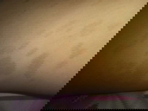 bercak hitam di tangan dan badan