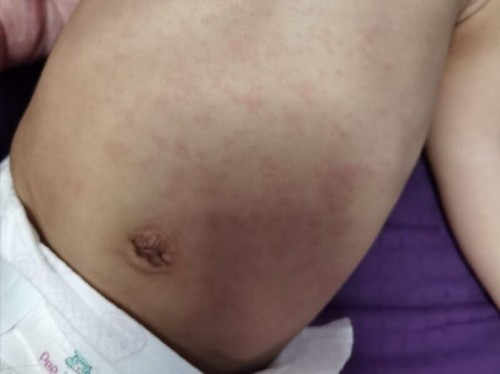 Redness after recovered fm fever