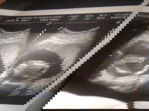 Ultrasound boy or girl?