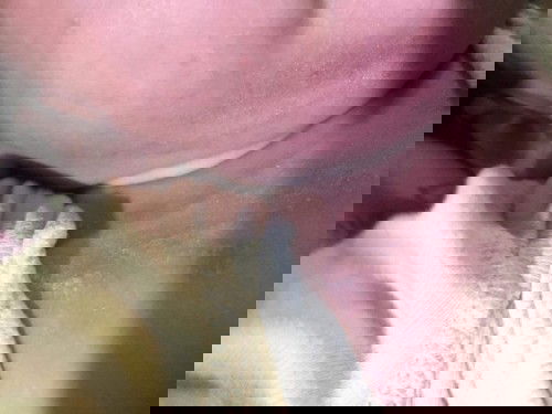 ผื่นแดงๆขึ้นแค่แถวคอ