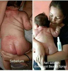 Obat Ruam Popok, brutusan atau biang keringat