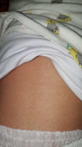 Radang tenggorokan pada bayi